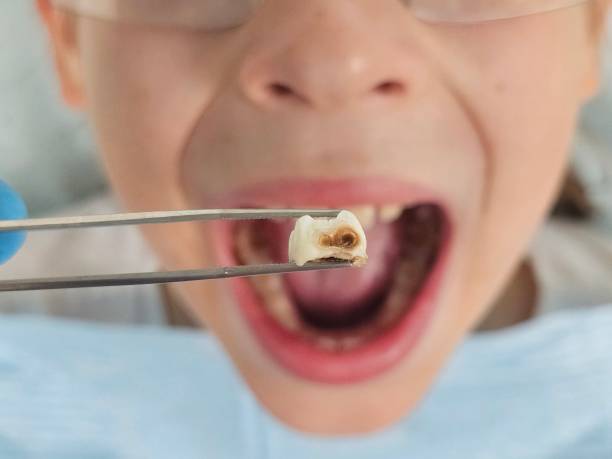 Best Emergency Dentist for Lost Fillings or Crowns in Irondale, GA